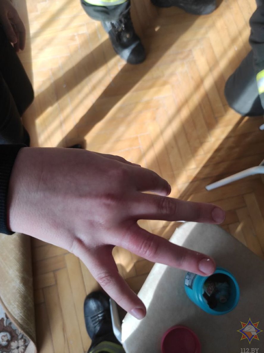 В Беларуси спасатели помогли снять застрявшее кольцо с пальца 8-летней девочки. Смотрите видео и фото
