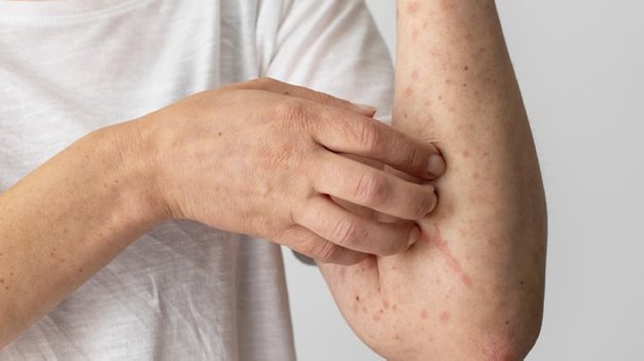 Минздрав: в Беларуси выявлено 15 случаев кори