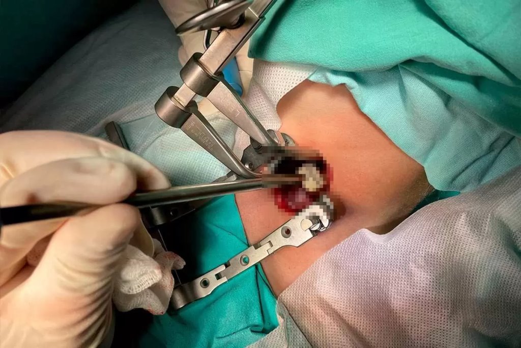 В Беларуси впервые провели операцию на позвоночнике с отечественным имплантатом