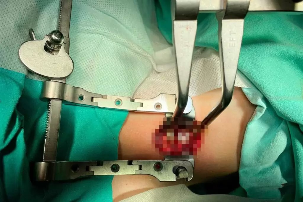 В Беларуси впервые провели операцию на позвоночнике с отечественным имплантатом