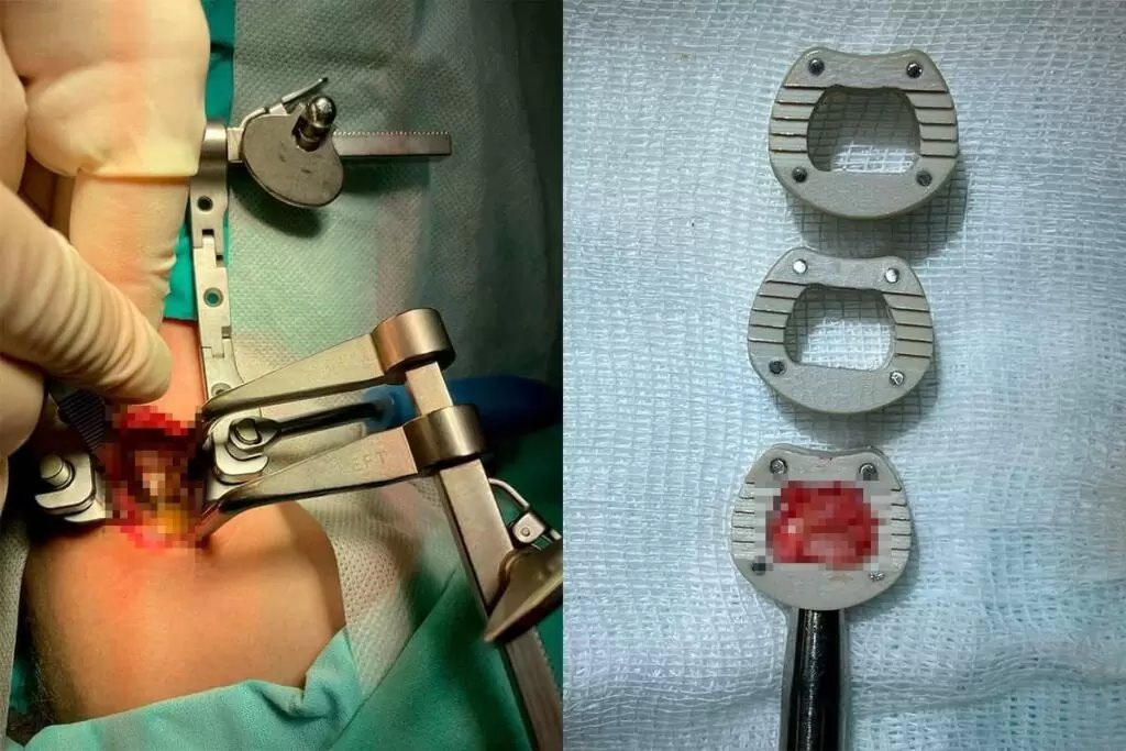 В Беларуси впервые провели операцию на позвоночнике с отечественным имплантатом