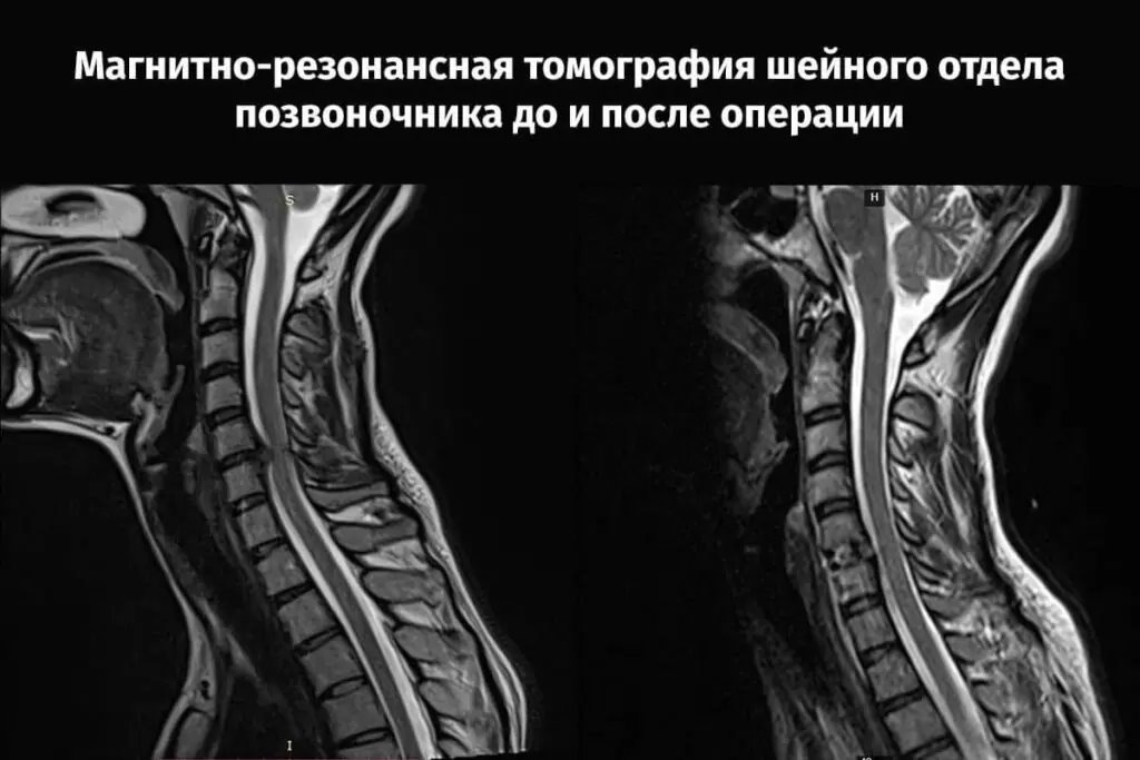В Беларуси впервые провели операцию на позвоночнике с отечественным имплантатом