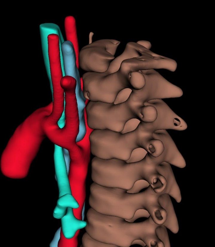 Белорусские врачи впервые выполнили уникальную операцию ребенку с двойной дугой аорты