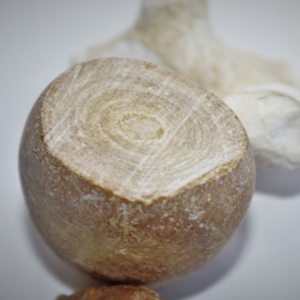 У белоруса нашли 4-сантиметровый почечный камень