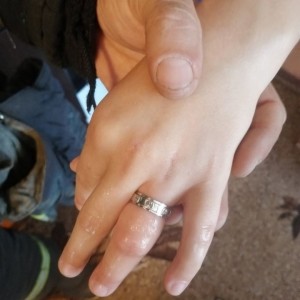 Белоруска не смогла снять кольцо — пришлось звать МЧС