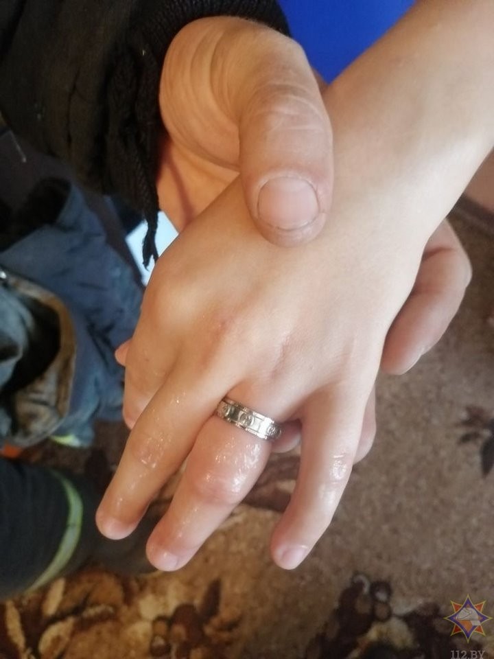 В Беларуси спасатели помогли ребенку снять кольцо с пальца