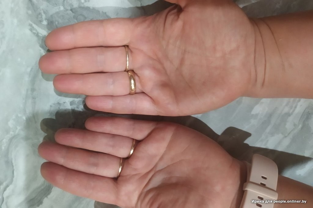 Гадюки действительно убивают? Истории реальных белорусов, которых кусала змея