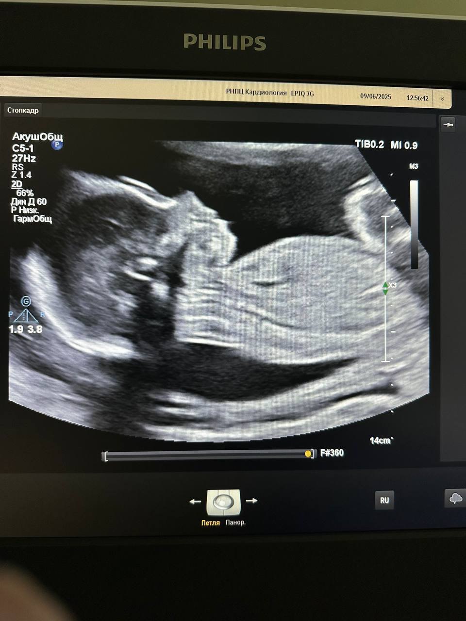 Уникальная операция: белорусские врачи прооперировали сердце беременной