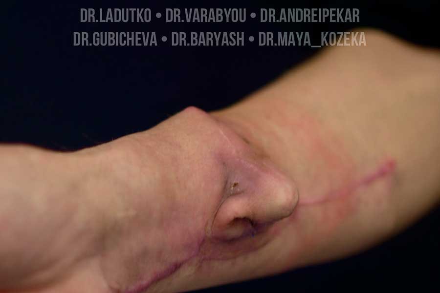 Белорусу пришили нос, выращенный на руке, – шокирующие кадры