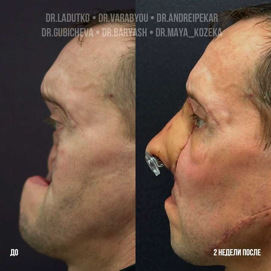 Белорусу пришили нос, выращенный на руке, – шокирующие кадры