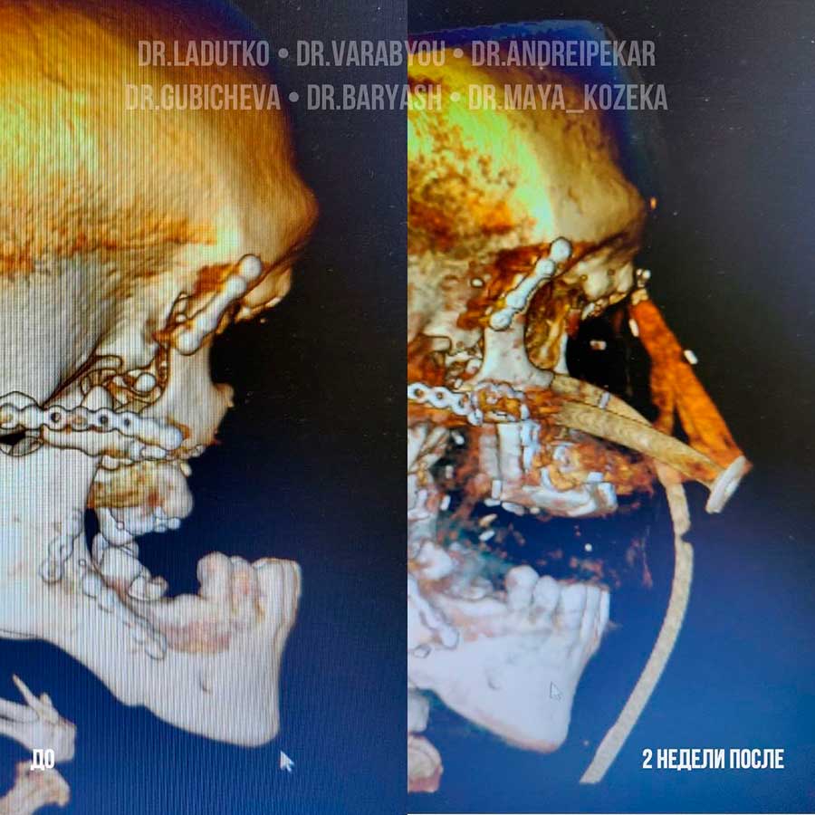 Белорусу пришили нос, выращенный на руке, – шокирующие кадры