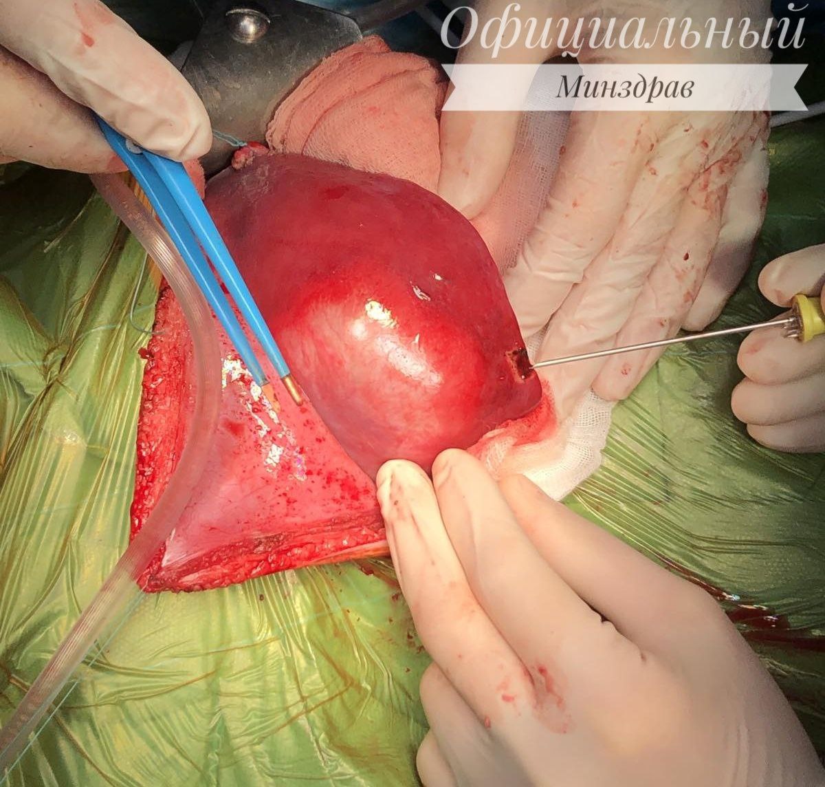 Впервые в Беларуси выполнено сложное хирургическое вмешательство