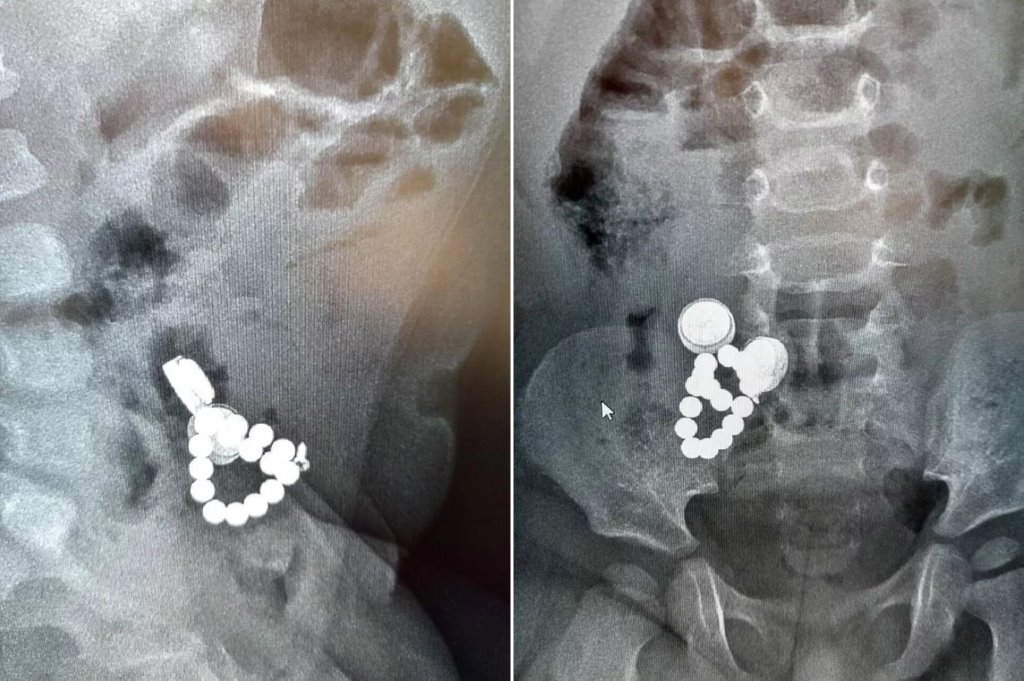 В Беларуси ребенок наглотался магнитов и батареек