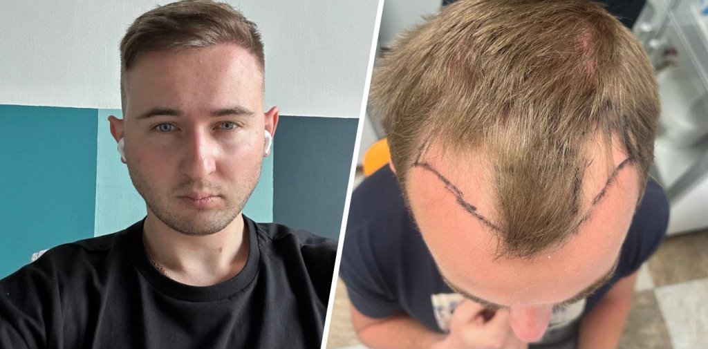 «Ощущение, будто 5 лет с себя сбросил». Парень решился на пересадку волос и показывает результаты