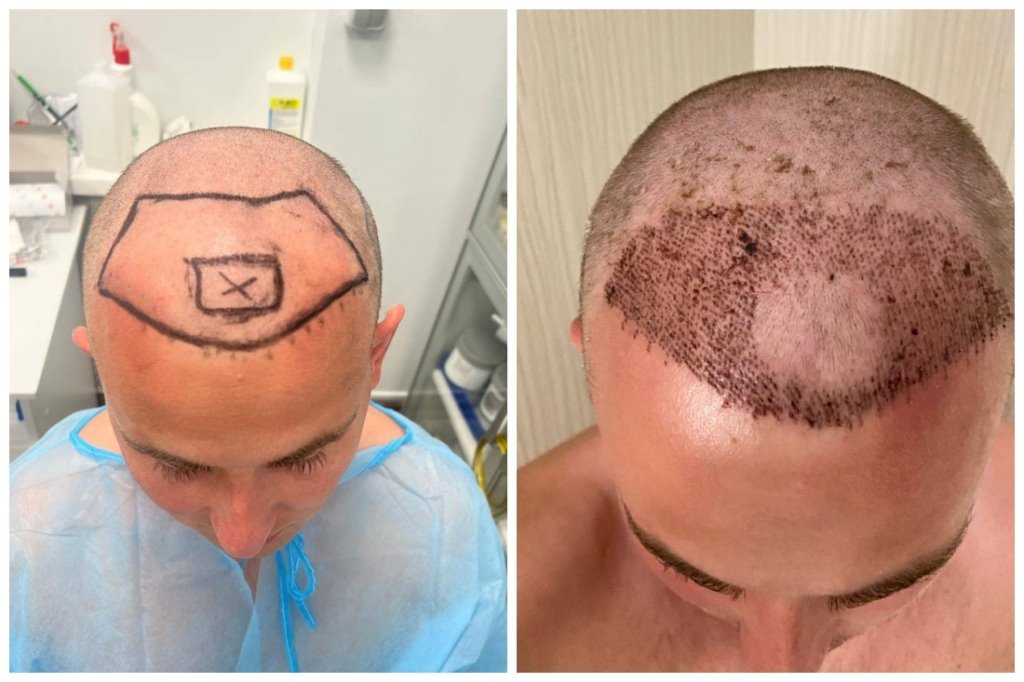 «Ощущение, будто 5 лет с себя сбросил». Парень решился на пересадку волос и показывает результаты