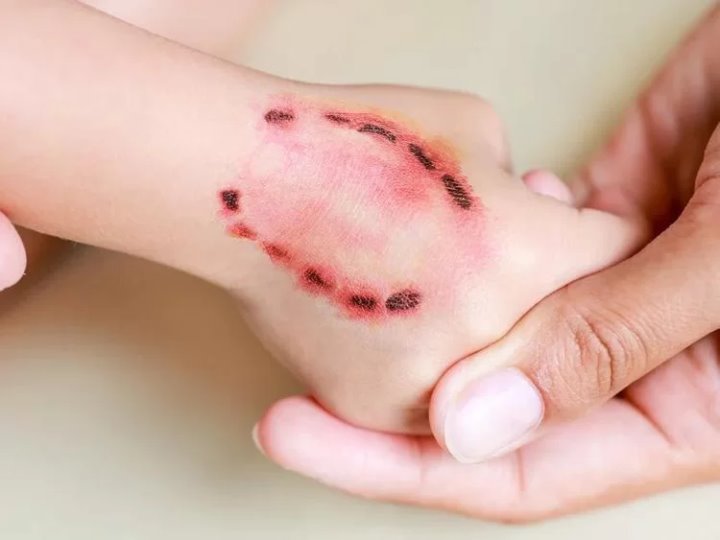 В Беларуси девочку-подростка покусала 49-летняя женщина. В чем причина необычного поведения