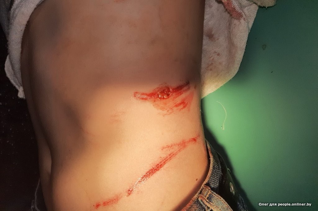 В Беларуси бультерьер набросился на 4-классницу, у нее рваные раны. Владельцы: он играл