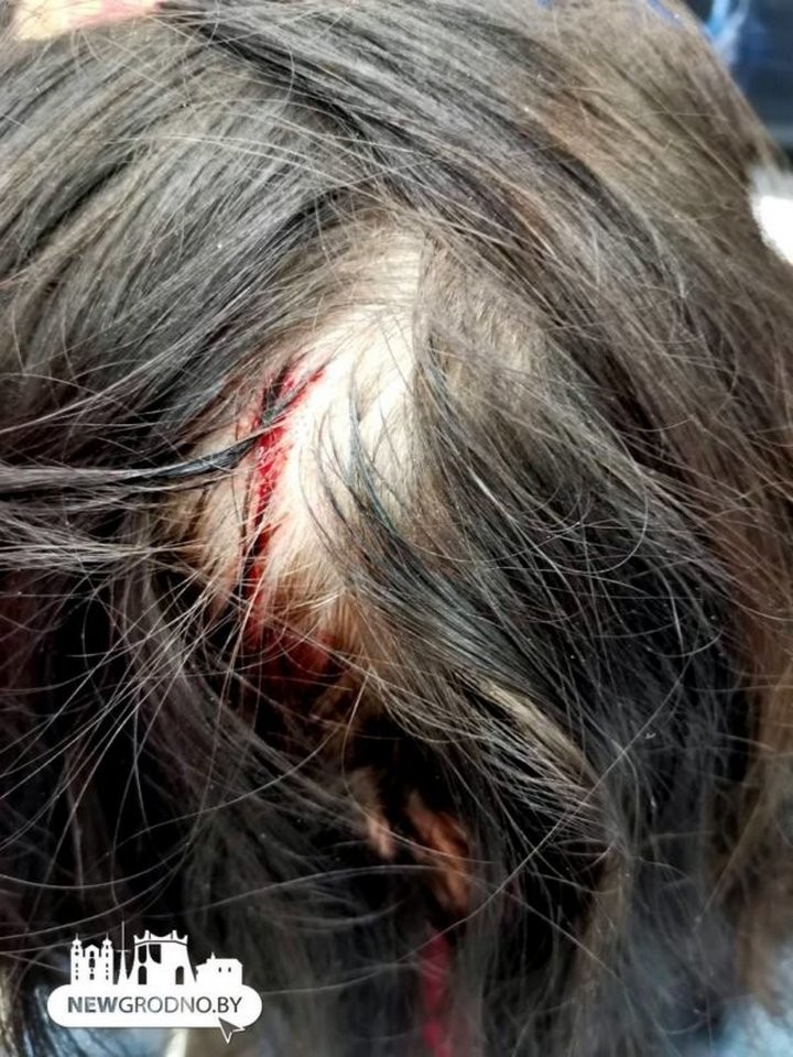 В Гродно на женщину напала ворона. На голове остались царапины