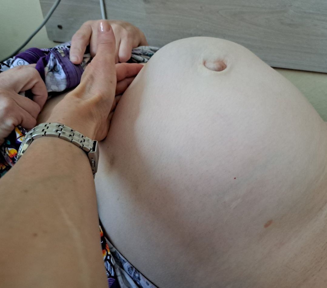 «Такие новообразования редкость». В Беларуси пациентке удалили огромную опухоль в 6 килограмм