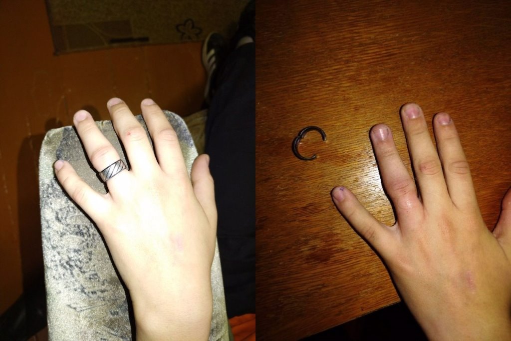 В Брестской области ребенок надел кольцо, но не смог его снять. Кто ему помог?