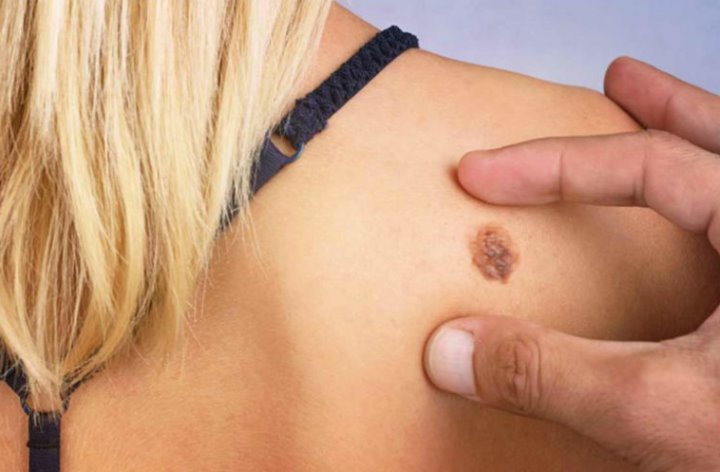 Онколог рассказал, как обнаружить опасные для жизни родинки