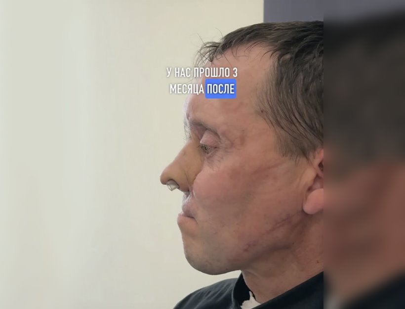 Помните мужчину, которому на руке вырастили нос? Хирург рассказал, как его дела