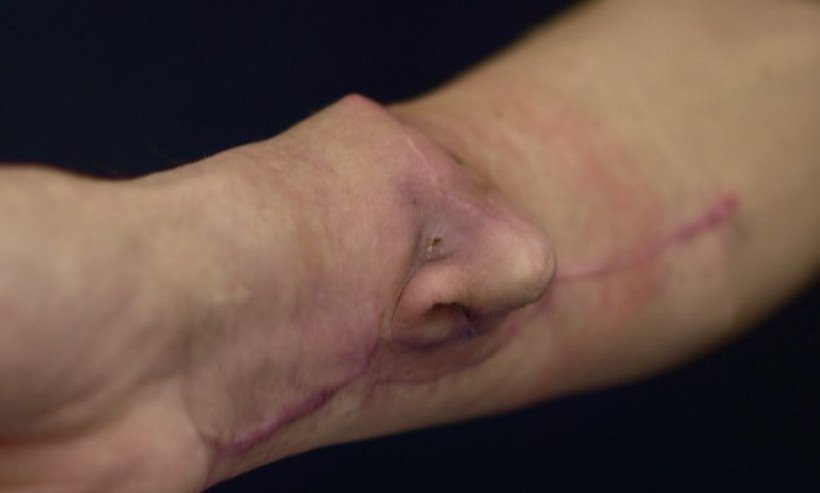 Помните мужчину, которому на руке вырастили нос? Хирург рассказал, как его дела