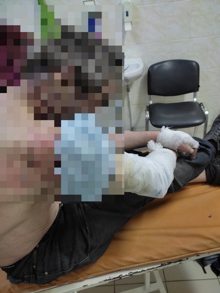 «Закурил, уснул, загорелась трава, получил ожоги»: мужчина получил ожоги от упавшего в сухую траву окурка