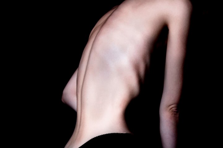 «Я весила 42 кг при росте 178 см»: история одной борьбы с анорексией