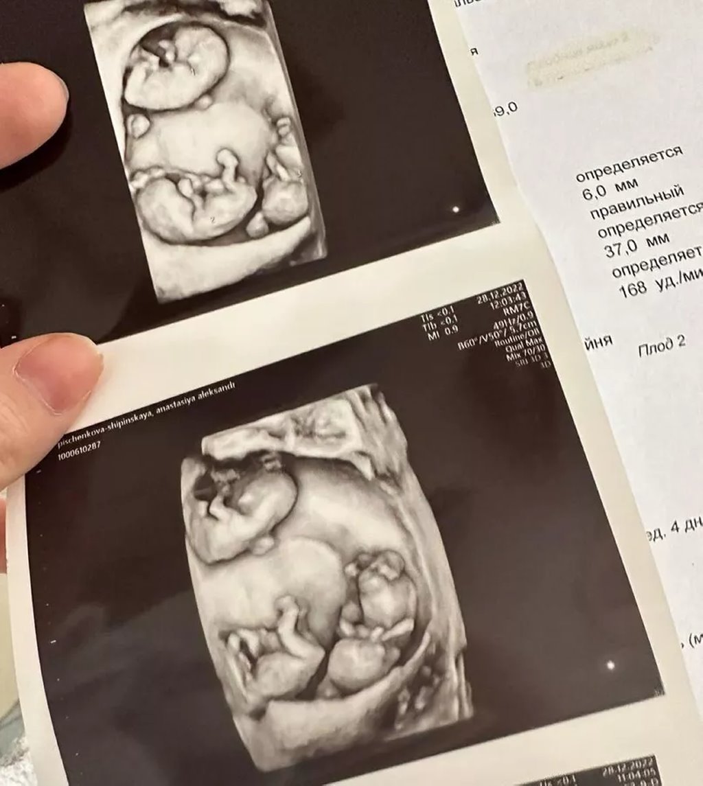 Один случай на 200 миллионов беременностей: гомельчанка родила трех близняшек