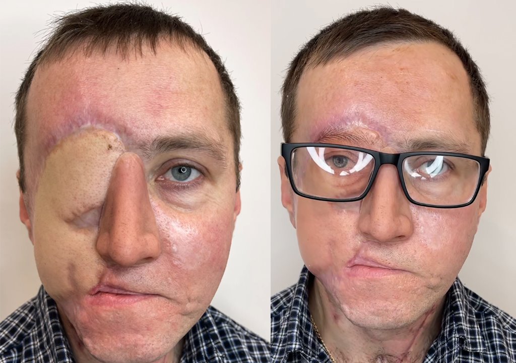 Тату-мастер нарисовала белорусу искусственный глаз — выглядит как настоящий