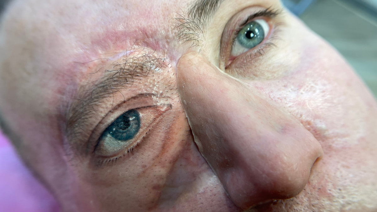 В Беларуси тату-мастер закончила набивать глаз пострадавшему в аварии парню. Вот результат