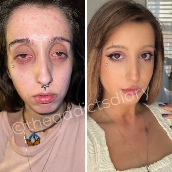 Посмотрите, как изменились завязавшие наркоманы и алкоголики