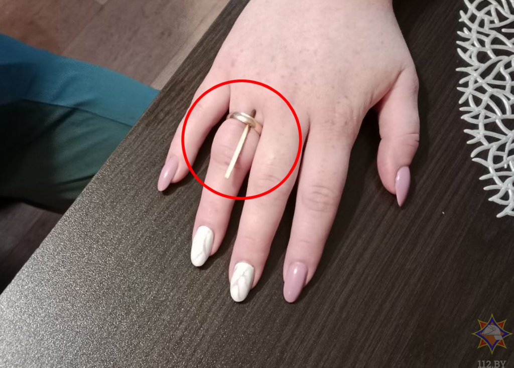 Спасатели помогли белоруске снять кольцо, застрявшее на пальце