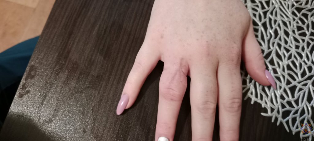 Спасатели помогли белоруске снять кольцо, застрявшее на пальце