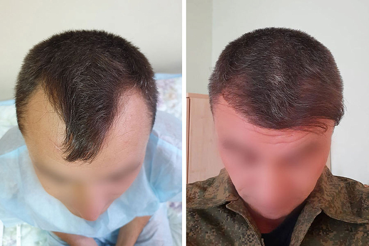 Как белорусы пересаживают волосы