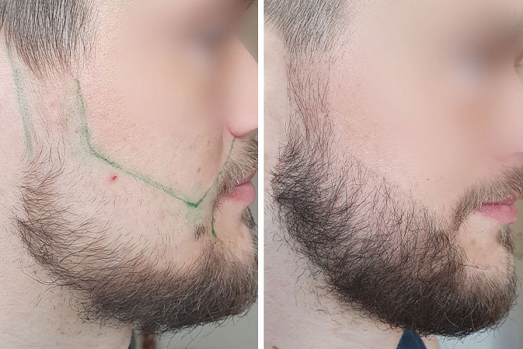 Как белорусы пересаживают волосы