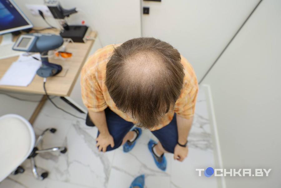 Как белорусы пересаживают волосы