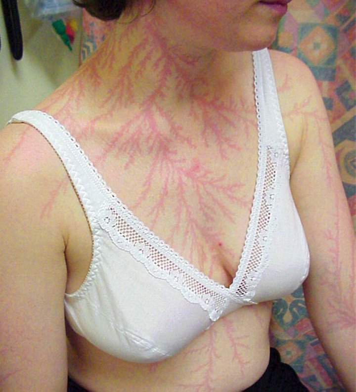 После разряда — что происходит с человеком, в которого ударила молния