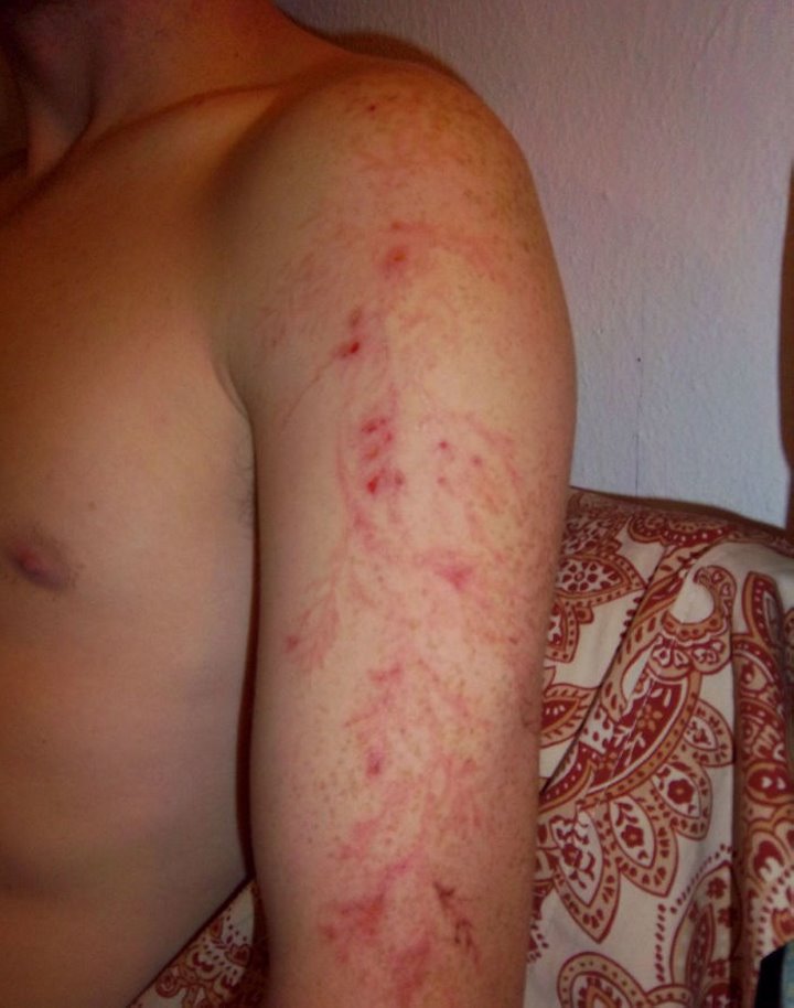 После разряда — что происходит с человеком, в которого ударила молния