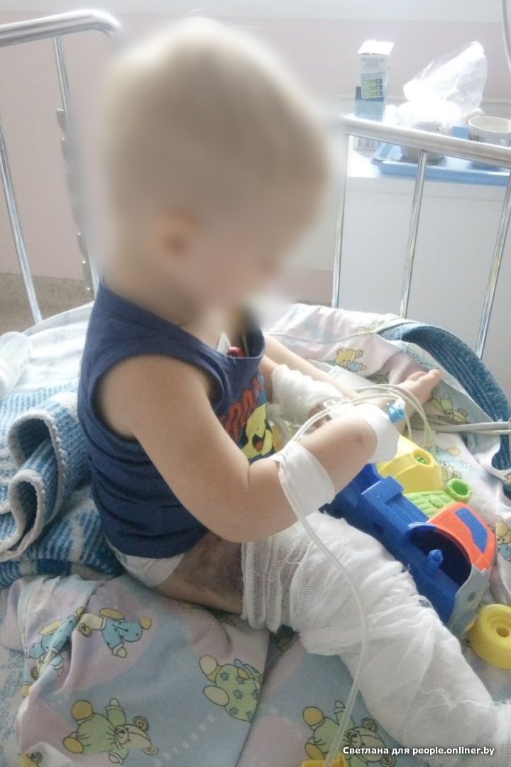 Нога опухла и почернела. Если гадюка укусила ребенка: вспоминаем последствия и учимся реагировать