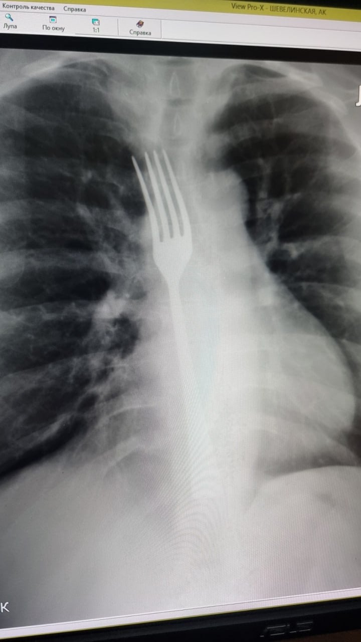 В Беларуси девушка проглотила вилку — вот как это произошло