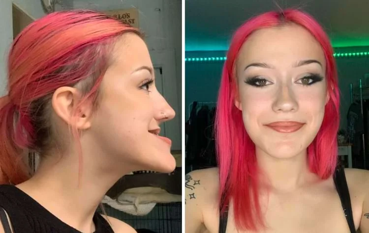 Девушка с розовыми волосами в профиль до и после двойной челюстной операции