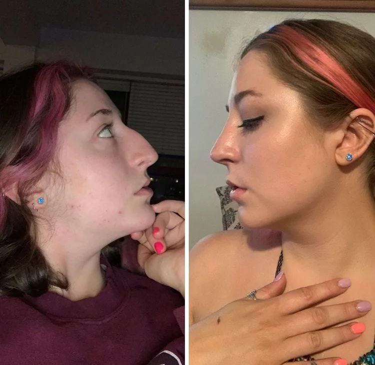 Девушка с розовыми прядями в профиль до и после ринопластики, трогает подбородок