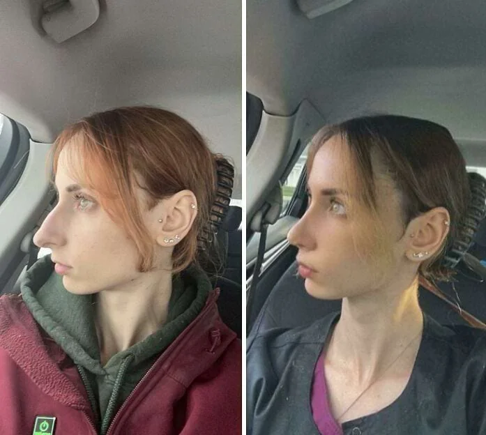 Профиль девушки с выраженной горбинкой носа до и после ринопластики