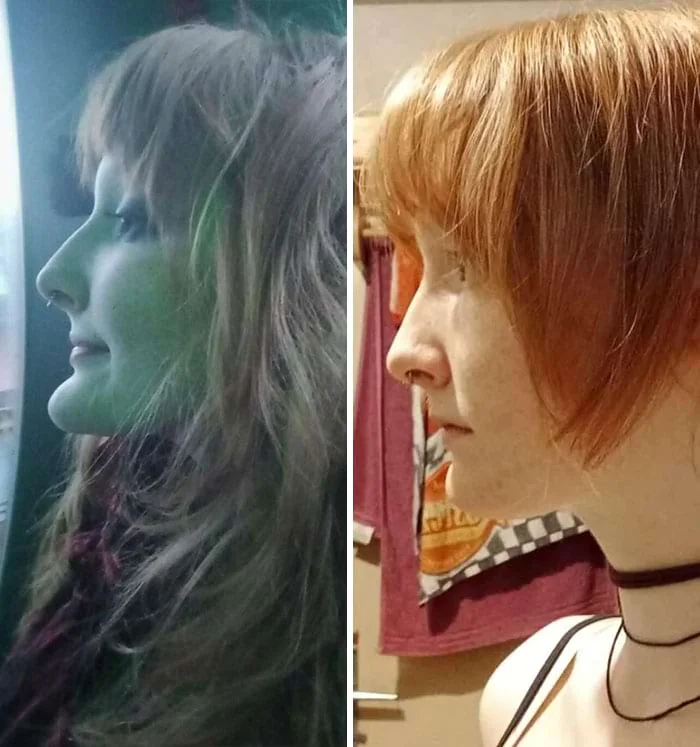 Профиль женщины с выступающим подбородком до и после операции по его уменьшению