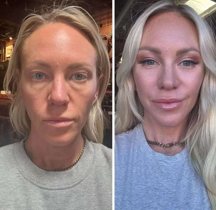 Женщина с обвисшей кожей и впалыми щеками до и после подтяжки с липофилингом