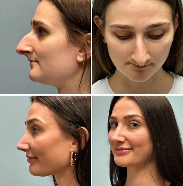 Профиль женщины с крючковатым носом до и после ринопластики с увеличением губ филлерами