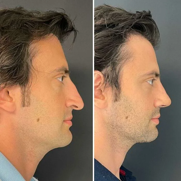 Мужской профиль до и после операции на подбородке и шее, улучшение контура нижней части лица
