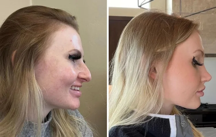 Профиль девушки с выступающим носом до и через 10 недель после ринопластики